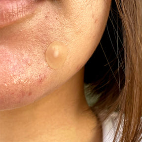 Salicylic Acid Acne Healing Dots